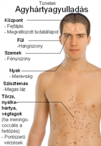 Symptoms_of_Meningitis-hu-208x300
