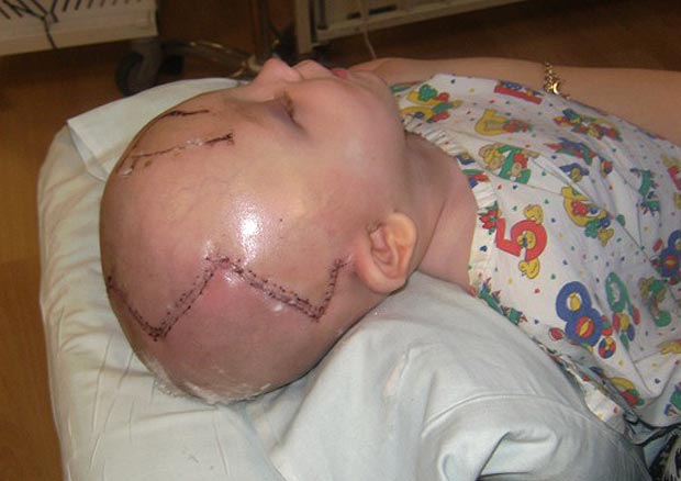 A kisfiú koponyáját újraépítették mielőtt összezúzta volna az agyát